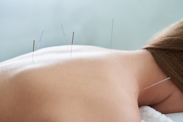 Benefits of Acupuncture in Pain Management